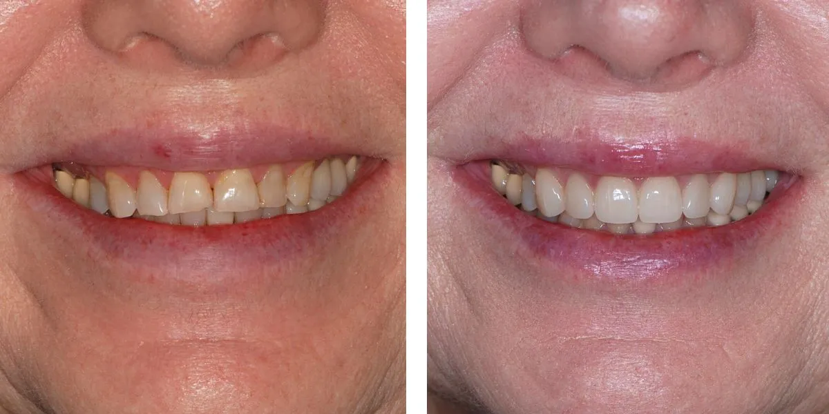Before and after treatment Nevins Dental Center