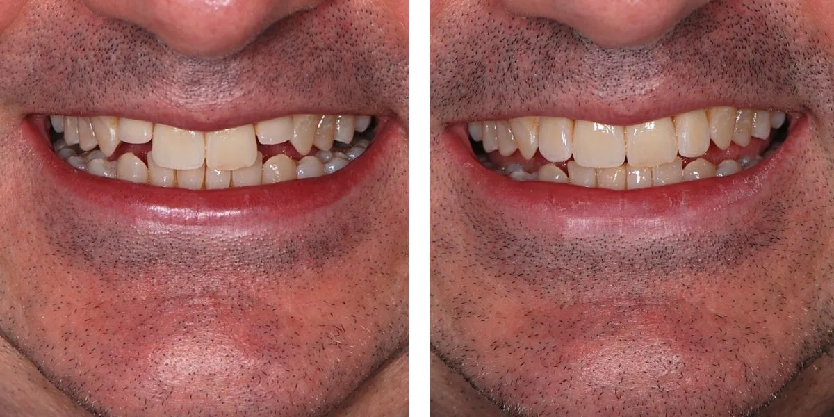 Before and after treatment Nevins Dental Center