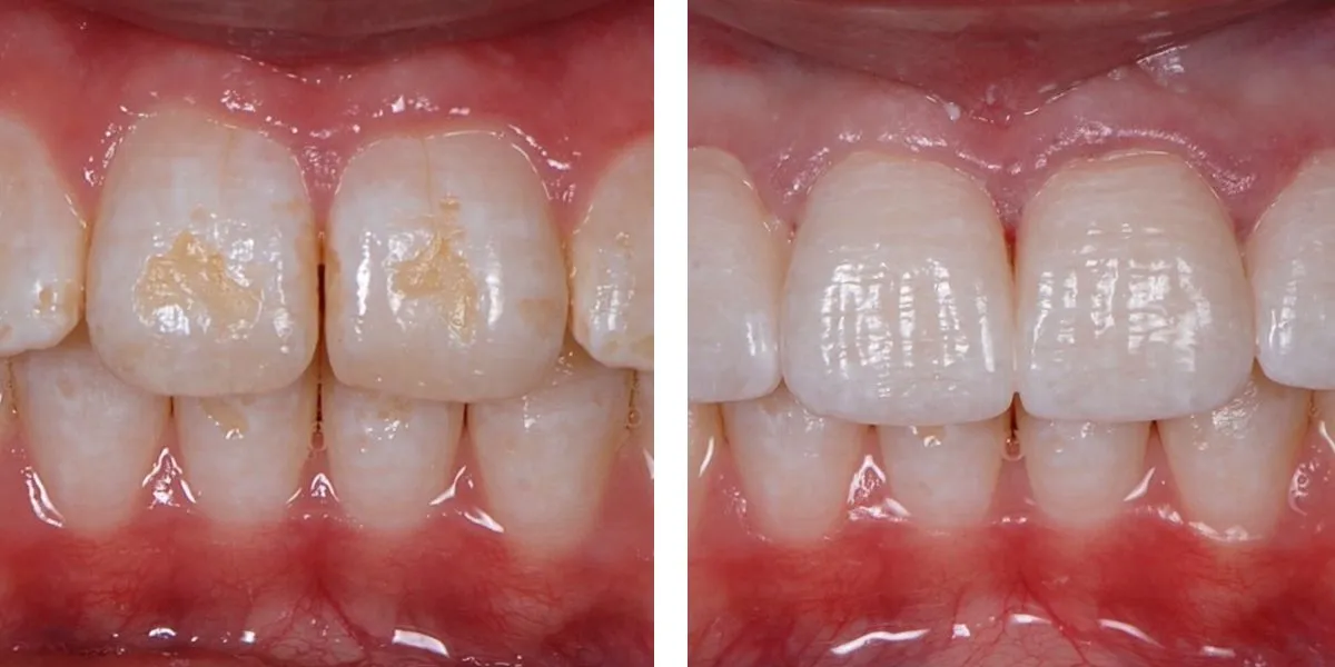 Before and after treatment Nevins Dental Center