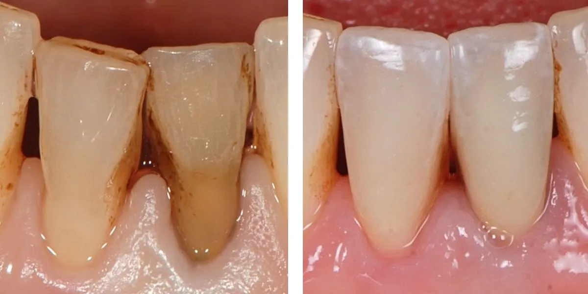 Before and after treatment Nevins Dental Center