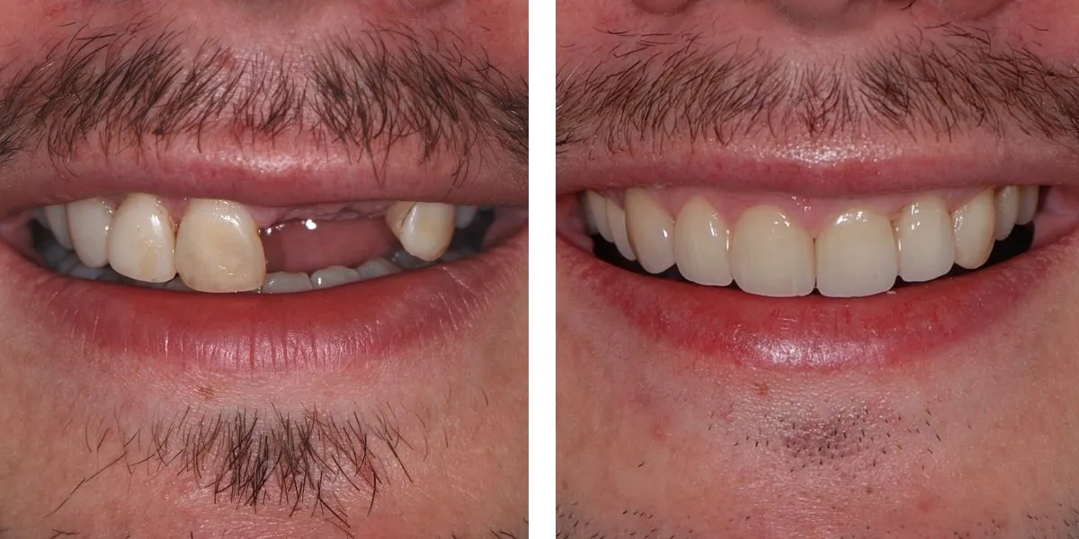 Before and after treatment Nevins Dental Center