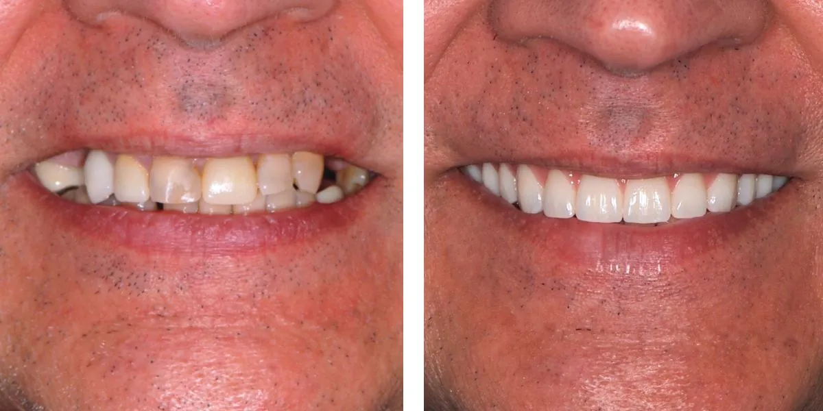 Before and after treatment Nevins Dental Center