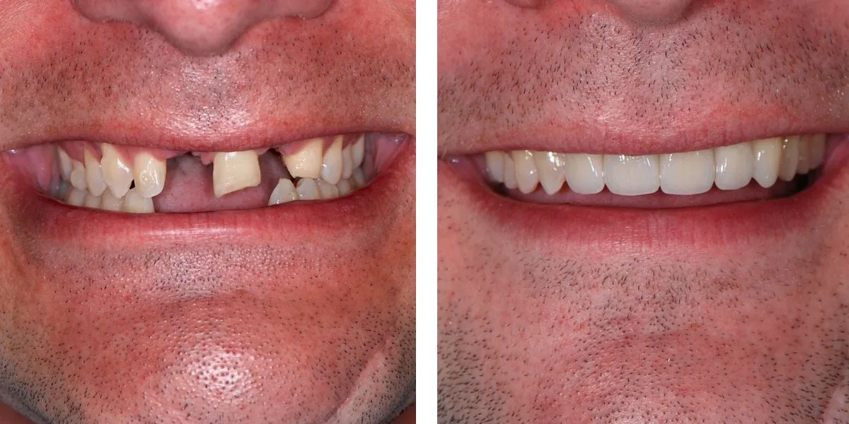 Before and after treatment Nevins Dental Center