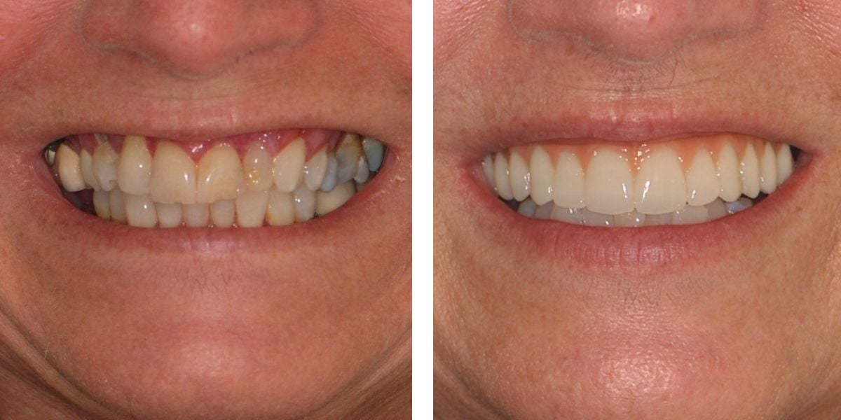 before and after treatment at Nevins Dental Center