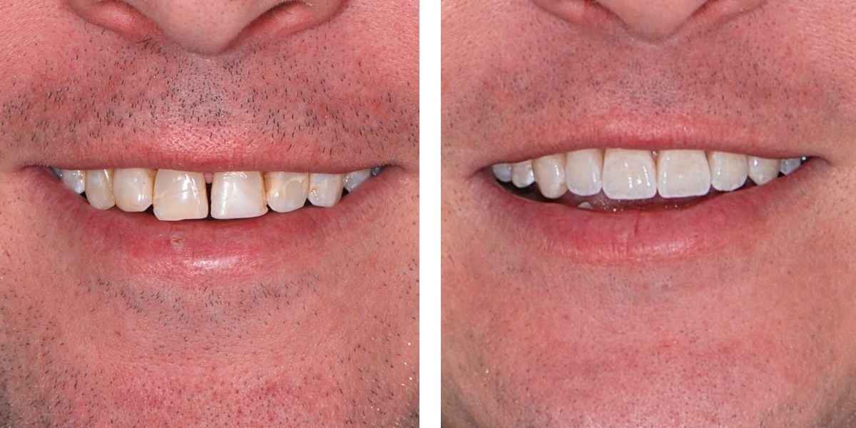 before and after treatment at Nevins Dental Center