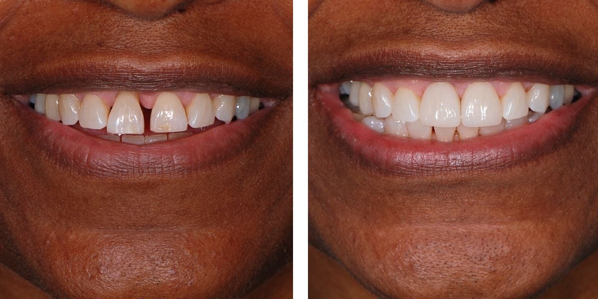 before and after treatment at Nevins Dental Center