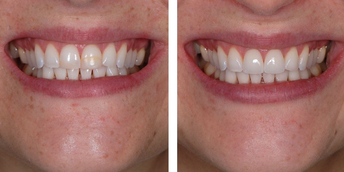 before and after treatment at Nevins Dental Center