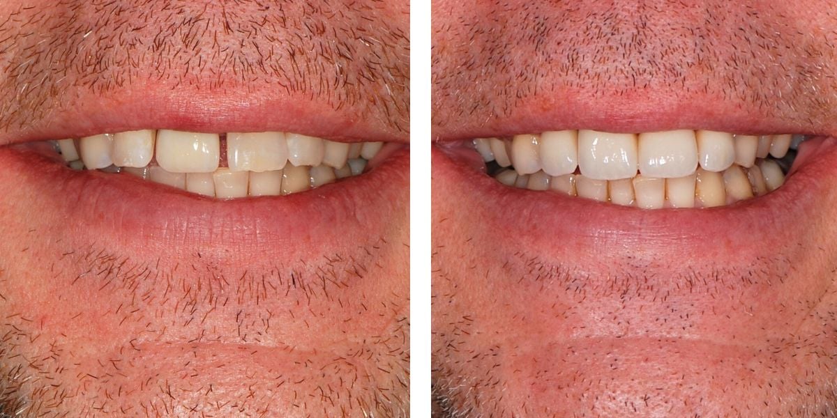 before and after treatment at Nevins Dental Center