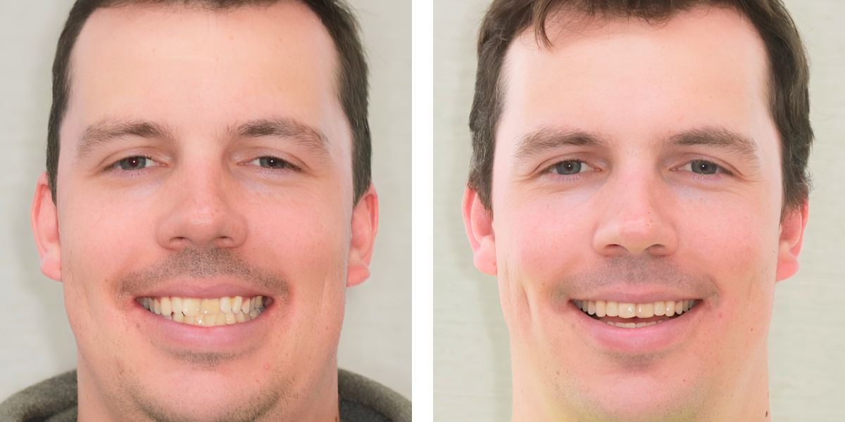 Before and After - Orthodontics