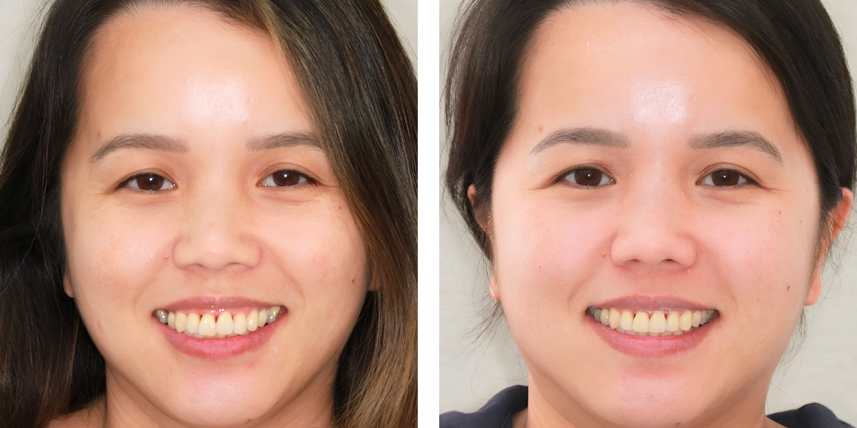 Before and After - Orthodontics