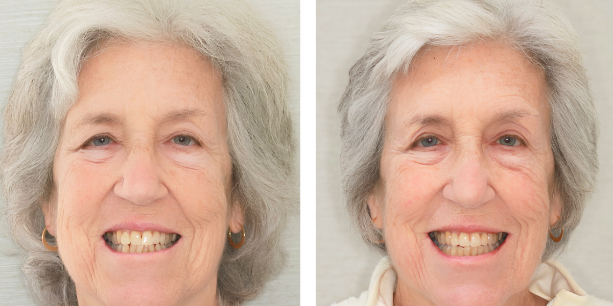 Before and After - Orthodontics